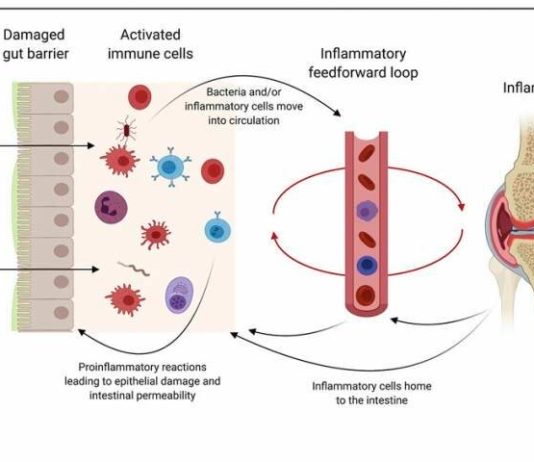 El intestino podría ser clave para aliviar la artritis reumatoide El intestino podría ser clave para aliviar la artritis reumatoide