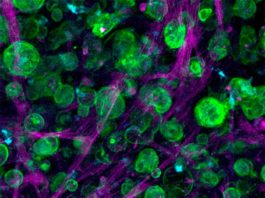 Modelos de tumores cultivados para tratar el cáncer de páncreas Cáncer de páncreas: Imagen de microscopía confocal de un cultivo triple de células de adenocarcinoma ductal pancreático (PDAC), macrófagos y células estrelladas pancreáticas incrustadas y creciendo dentro de la matriz diseñada