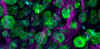 Modelos de tumores cultivados para tratar el cáncer de páncreas Cáncer de páncreas: Imagen de microscopía confocal de un cultivo triple de células de adenocarcinoma ductal pancreático (PDAC), macrófagos y células estrelladas pancreáticas incrustadas y creciendo dentro de la matriz diseñada