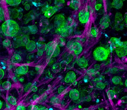 Modelos de tumores cultivados para tratar el cáncer de páncreas Cáncer de páncreas: Imagen de microscopía confocal de un cultivo triple de células de adenocarcinoma ductal pancreático (PDAC), macrófagos y células estrelladas pancreáticas incrustadas y creciendo dentro de la matriz diseñada