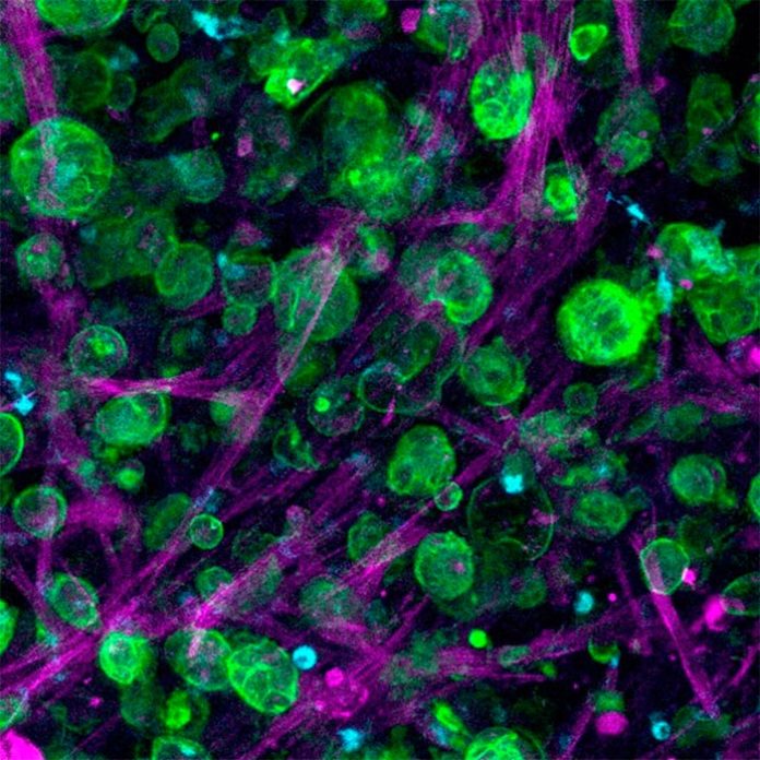 Cáncer de páncreas: Imagen de microscopía confocal de un cultivo triple de células de adenocarcinoma ductal pancreático (PDAC), macrófagos y células estrelladas pancreáticas incrustadas y creciendo dentro de la matriz diseñada Cáncer de páncreas: Imagen de microscopía confocal de un cultivo triple de células de adenocarcinoma ductal pancreático (PDAC), macrófagos y células estrelladas pancreáticas incrustadas y creciendo dentro de la matriz diseñada
