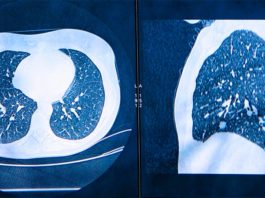 La inteligencia artificial podría ayudar a diagnosticar el cáncer de pulmón un año antes Tomografías computarizadas para detectar cáncer de pulmón