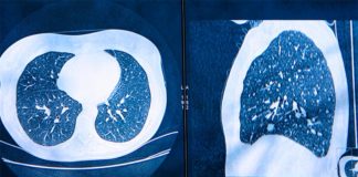 La inteligencia artificial podría ayudar a diagnosticar el cáncer de pulmón un año antes Tomografías computarizadas para detectar cáncer de pulmón