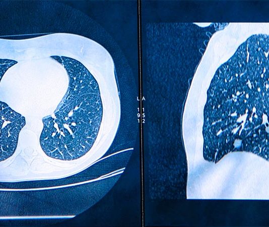 La inteligencia artificial podría ayudar a diagnosticar el cáncer de pulmón un año antes Tomografías computarizadas para detectar cáncer de pulmón