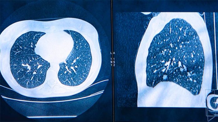 Tomografías computarizadas para detectar cáncer de pulmón