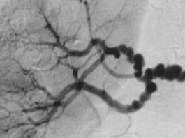 Nuevos genes identificados en la displasia fibromuscular La característica "cadena de cuentas" en la displasia fibromuscular medial