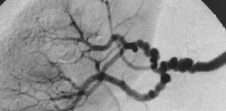 Nuevos genes identificados en la displasia fibromuscular La característica "cadena de cuentas" en la displasia fibromuscular medial
