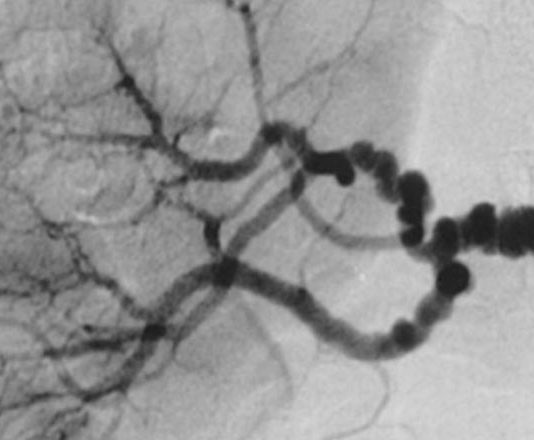 Nuevos genes identificados en la displasia fibromuscular La característica "cadena de cuentas" en la displasia fibromuscular medial