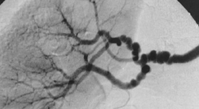 La característica "cadena de cuentas" en la displasia fibromuscular medial La característica "cadena de cuentas" en la displasia fibromuscular medial