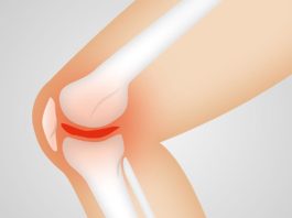 Investigadores identifican los genes que intervienen en la osteoartritis Osteoartritis