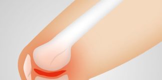 Investigadores identifican los genes que intervienen en la osteoartritis Osteoartritis