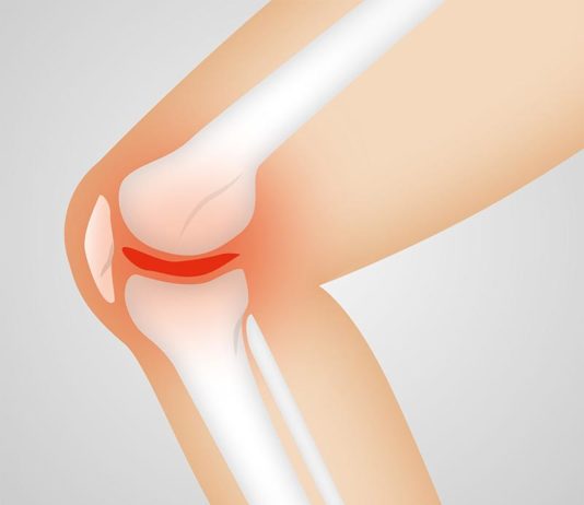 Investigadores identifican los genes que intervienen en la osteoartritis Osteoartritis