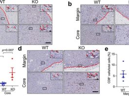 Identifican una molécula que impide que las células inmunitarias eliminen ciertos tipos de cáncer de mama En ciertos tipos de cáncer de mama, la molécula DDR1 coloca una barrera física para las células inmunitarias antitumorales