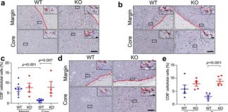 Identifican una molécula que impide que las células inmunitarias eliminen ciertos tipos de cáncer de mama En ciertos tipos de cáncer de mama, la molécula DDR1 coloca una barrera física para las células inmunitarias antitumorales