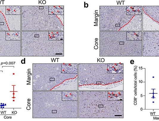 Identifican una molécula que impide que las células inmunitarias eliminen ciertos tipos de cáncer de mama En ciertos tipos de cáncer de mama, la molécula DDR1 coloca una barrera física para las células inmunitarias antitumorales
