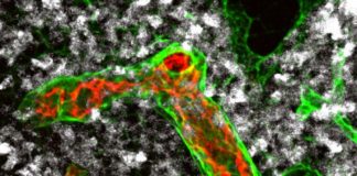 Cómo el linfoma no Hodgkin dificulta la lucha de las células inmunes Las células inmunitarias pueden migrar a los ganglios linfáticos a través de vasos sanguíneos particularmente grandes (rojo y verde en la imagen) y destruir las células tumorales existentes (blancas). Estos vasos se remodelan gradualmente en el linfoma no Hodgkin agresivo