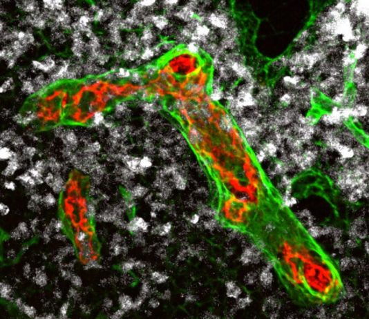Cómo el linfoma no Hodgkin dificulta la lucha de las células inmunes Las células inmunitarias pueden migrar a los ganglios linfáticos a través de vasos sanguíneos particularmente grandes (rojo y verde en la imagen) y destruir las células tumorales existentes (blancas). Estos vasos se remodelan gradualmente en el linfoma no Hodgkin agresivo