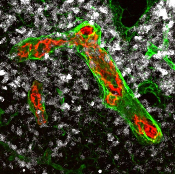Las células inmunitarias pueden migrar a los ganglios linfáticos a través de vasos sanguíneos particularmente grandes (rojo y verde en la imagen) y destruir las células tumorales existentes (blancas). Estos vasos se remodelan gradualmente en el linfoma no Hodgkin agresivo