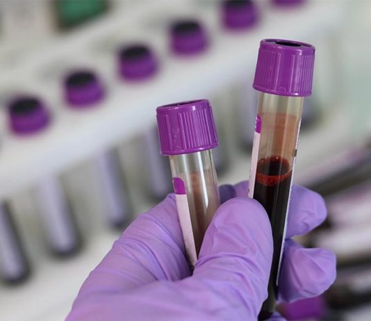 Un nuevo análisis de sangre puede identificar si un paciente tiene cáncer y si se ha extendido Un nuevo análisis de sangre puede identificar si un paciente tiene cáncer y si se ha extendido