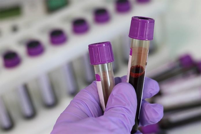 Un nuevo análisis de sangre puede identificar si un paciente tiene cáncer y si se ha extendido