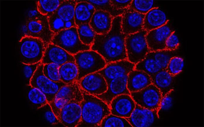 Células de cáncer de páncreas (azul) creciendo como una esfera encerrada en membranas (roja)