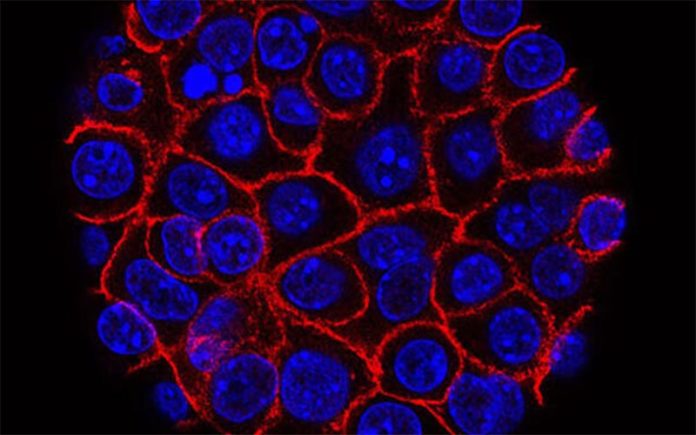 Células de cáncer de páncreas (azul) creciendo como una esfera encerrada en membranas (roja) Células de cáncer de páncreas (azul) creciendo como una esfera encerrada en membranas (roja)