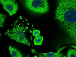 Cómo las células forman una primera línea de defensa contra el cáncer de piel en ratones Cáncer de piel: Queratinocitos en proceso de división celular rodeados de queratinocitos senescentes. El tamaño total de las células y su núcleo son una característica típica de la senescencia, que juegan un papel importante en la supresión tumoral