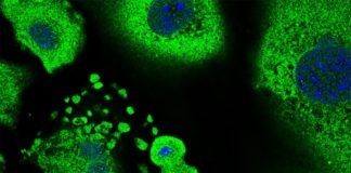 Cómo las células forman una primera línea de defensa contra el cáncer de piel en ratones Cáncer de piel: Queratinocitos en proceso de división celular rodeados de queratinocitos senescentes. El tamaño total de las células y su núcleo son una característica típica de la senescencia, que juegan un papel importante en la supresión tumoral