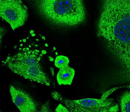 Cómo las células forman una primera línea de defensa contra el cáncer de piel en ratones Cáncer de piel: Queratinocitos en proceso de división celular rodeados de queratinocitos senescentes. El tamaño total de las células y su núcleo son una característica típica de la senescencia, que juegan un papel importante en la supresión tumoral