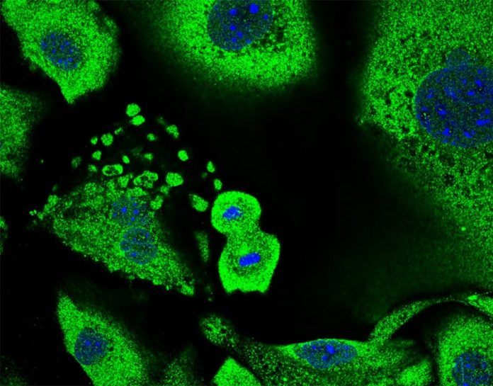Cáncer de piel: Queratinocitos en proceso de división celular rodeados de queratinocitos senescentes. El tamaño total de las células y su núcleo son una característica típica de la senescencia, que juegan un papel importante en la supresión tumoral Cáncer de piel: Queratinocitos en proceso de división celular rodeados de queratinocitos senescentes. El tamaño total de las células y su núcleo son una característica típica de la senescencia, que juegan un papel importante en la supresión tumoral