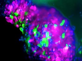 Incrementan radicalmente la eficacia de la inmunoterapia en cáncer de mama Organoide de cáncer de mama triple negativo, donde las células de color verde son las células madre cancerígenas que no expresan LCOR