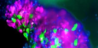 Incrementan radicalmente la eficacia de la inmunoterapia en cáncer de mama Organoide de cáncer de mama triple negativo, donde las células de color verde son las células madre cancerígenas que no expresan LCOR