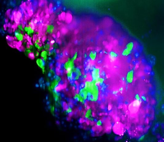 Incrementan radicalmente la eficacia de la inmunoterapia en cáncer de mama Organoide de cáncer de mama triple negativo, donde las células de color verde son las células madre cancerígenas que no expresan LCOR