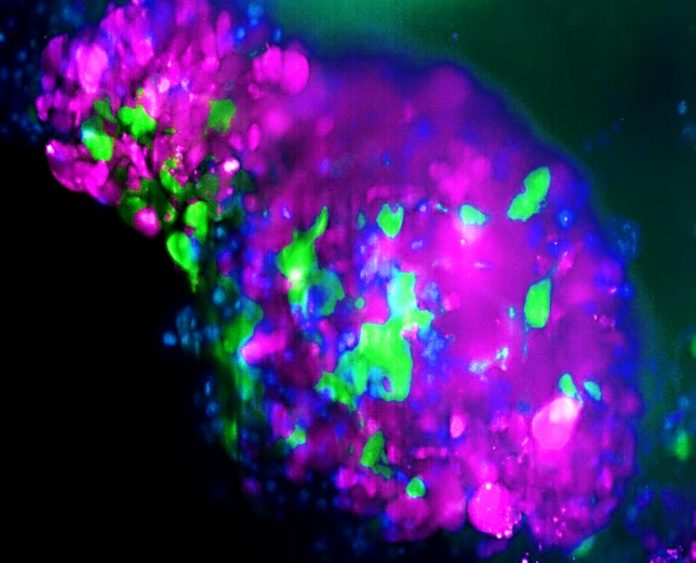 Organoide de cáncer de mama triple negativo, donde las células de color verde son las células madre cancerígenas que no expresan LCOR Organoide de cáncer de mama triple negativo, donde las células de color verde son las células madre cancerígenas que no expresan LCOR