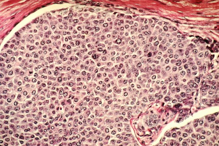 Células de cáncer de mama