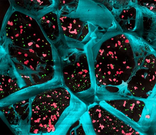 Gel biodegradable aumenta la respuesta del sistema inmunológico contra varios tipos de cáncer en ratones Una gran ampliación del hidrogel (en azul) que encapsula las plaquetas que activan las células T (en rojo) y las nanopartículas que liberan un fármaco para inhibir las células que estimulan los tumores en el cáncer (en verde)