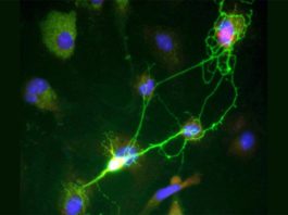 Los errores en el ADN se acumulan en el cerebro más rápido con el Alzheimer Neuronas y Alzheimer