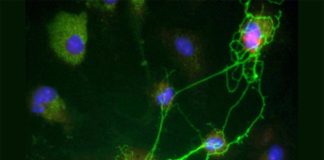 Los errores en el ADN se acumulan en el cerebro más rápido con el Alzheimer Neuronas y Alzheimer