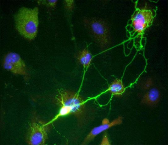 Los errores en el ADN se acumulan en el cerebro más rápido con el Alzheimer Neuronas y Alzheimer