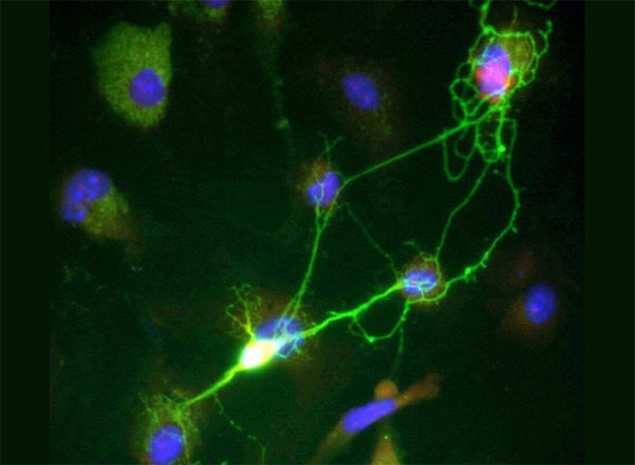 Neuronas y Alzheimer