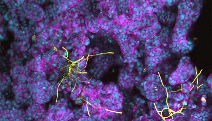 Candida albicans (amarillo) formando hifas en células epiteliales intestinales diferenciadas