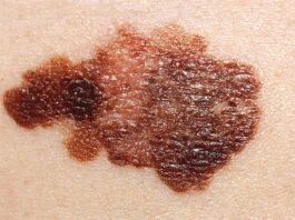 Combinación de fármacos activa la inmunidad de las células asesinas naturales contra el cáncer Melanoma