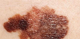 Combinación de fármacos activa la inmunidad de las células asesinas naturales contra el cáncer Melanoma