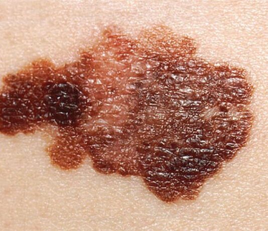 Combinación de fármacos activa la inmunidad de las células asesinas naturales contra el cáncer Melanoma