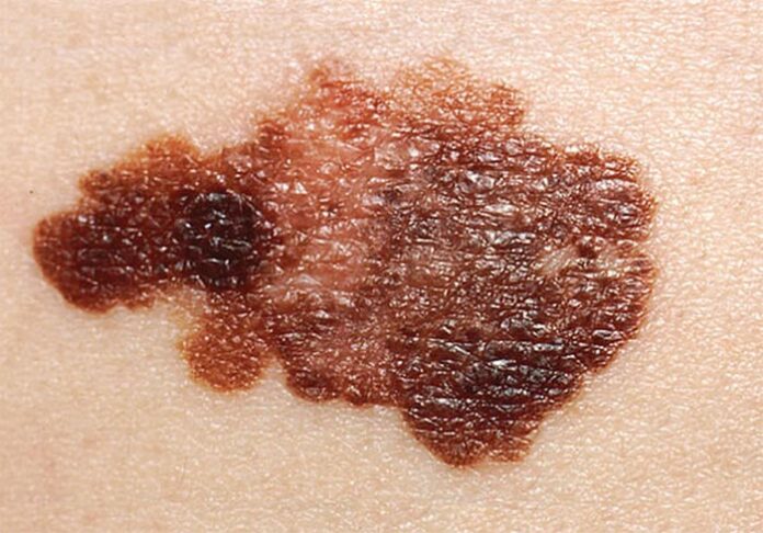 Melanoma