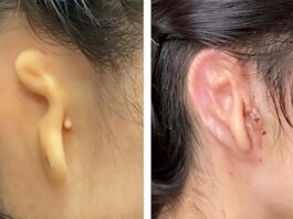 Microtia: Cirujanos trasplantan una oreja en 3D hecha de células vivas La oreja con microtia antes de la intervención y 30 días después