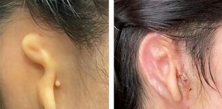 Microtia: Cirujanos trasplantan una oreja en 3D hecha de células vivas La oreja con microtia antes de la intervención y 30 días después