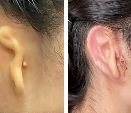 Microtia: Cirujanos trasplantan una oreja en 3D hecha de células vivas La oreja con microtia antes de la intervención y 30 días después