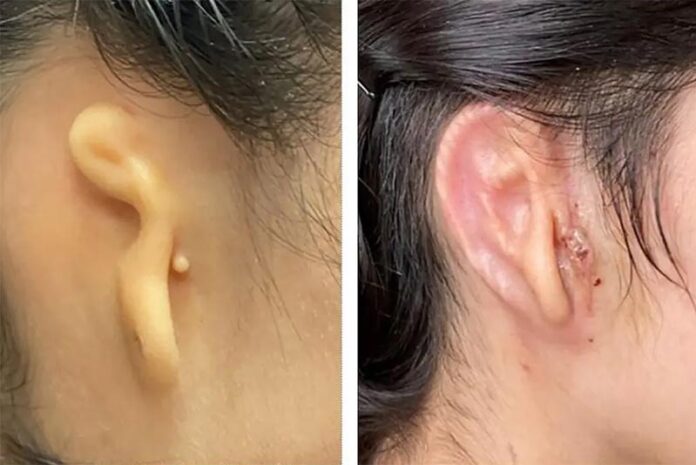 La oreja con microtia antes de la intervención y 30 días después