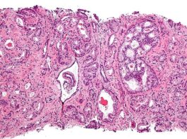 Identificados los mecanismos moleculares que regulan la hipoxia del cáncer de próstata Micrografía que muestra adenocarcinoma acinar prostático (la forma más común de cáncer de próstata)